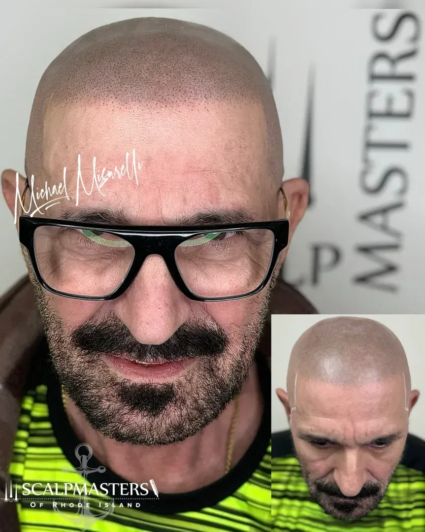 scalp micropigmentation for FUE scars