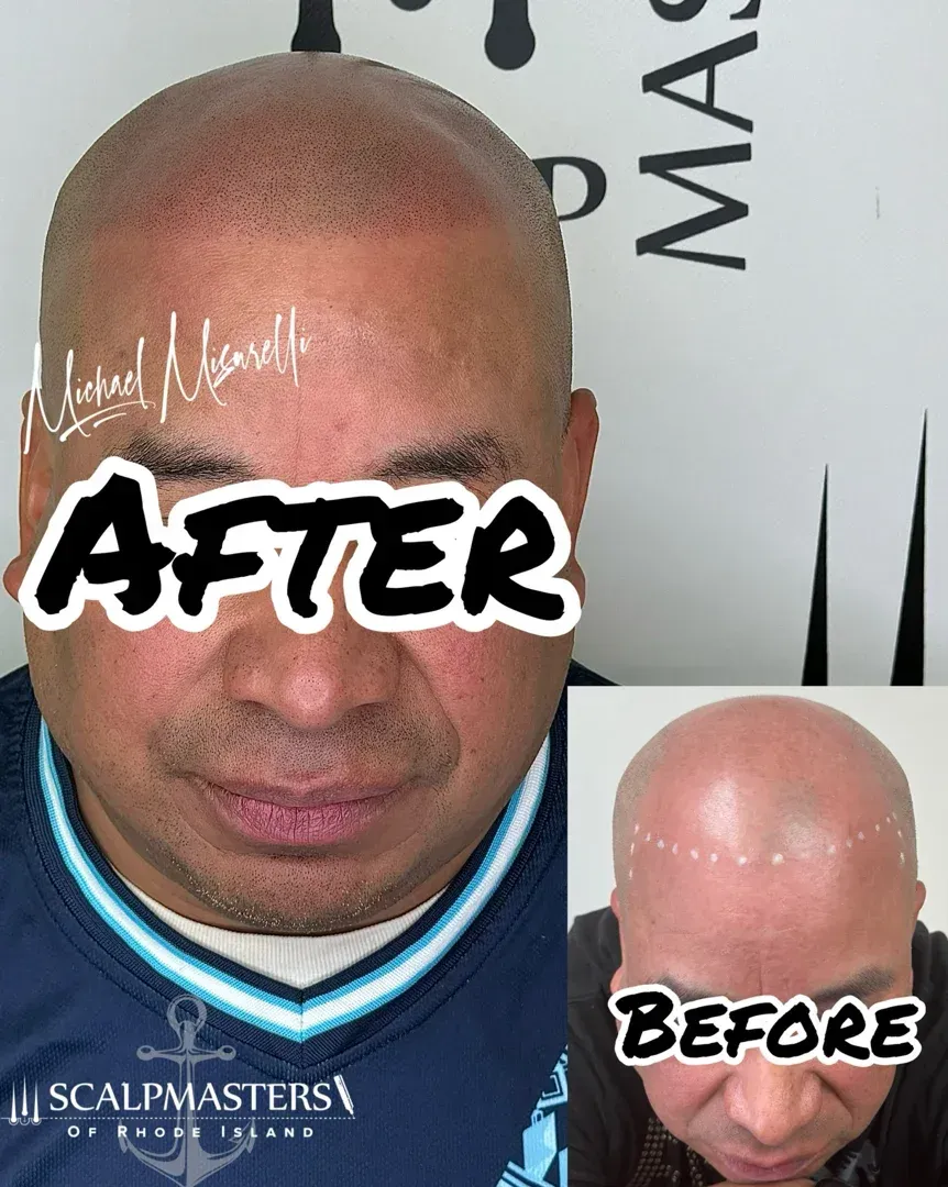 scalp micropigmentation scars