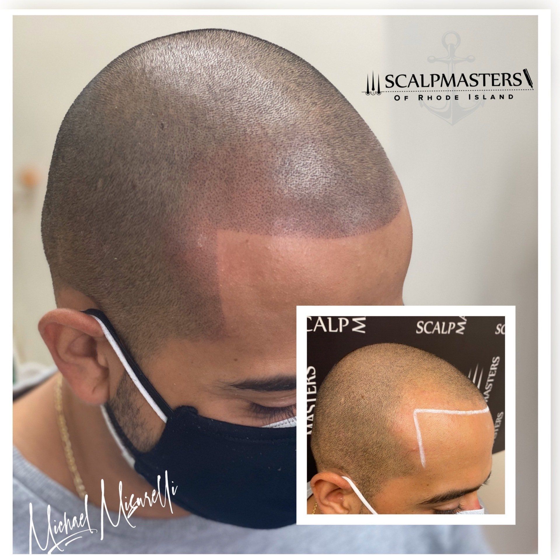 Scalp Micropigmentation in Treating Alopecia