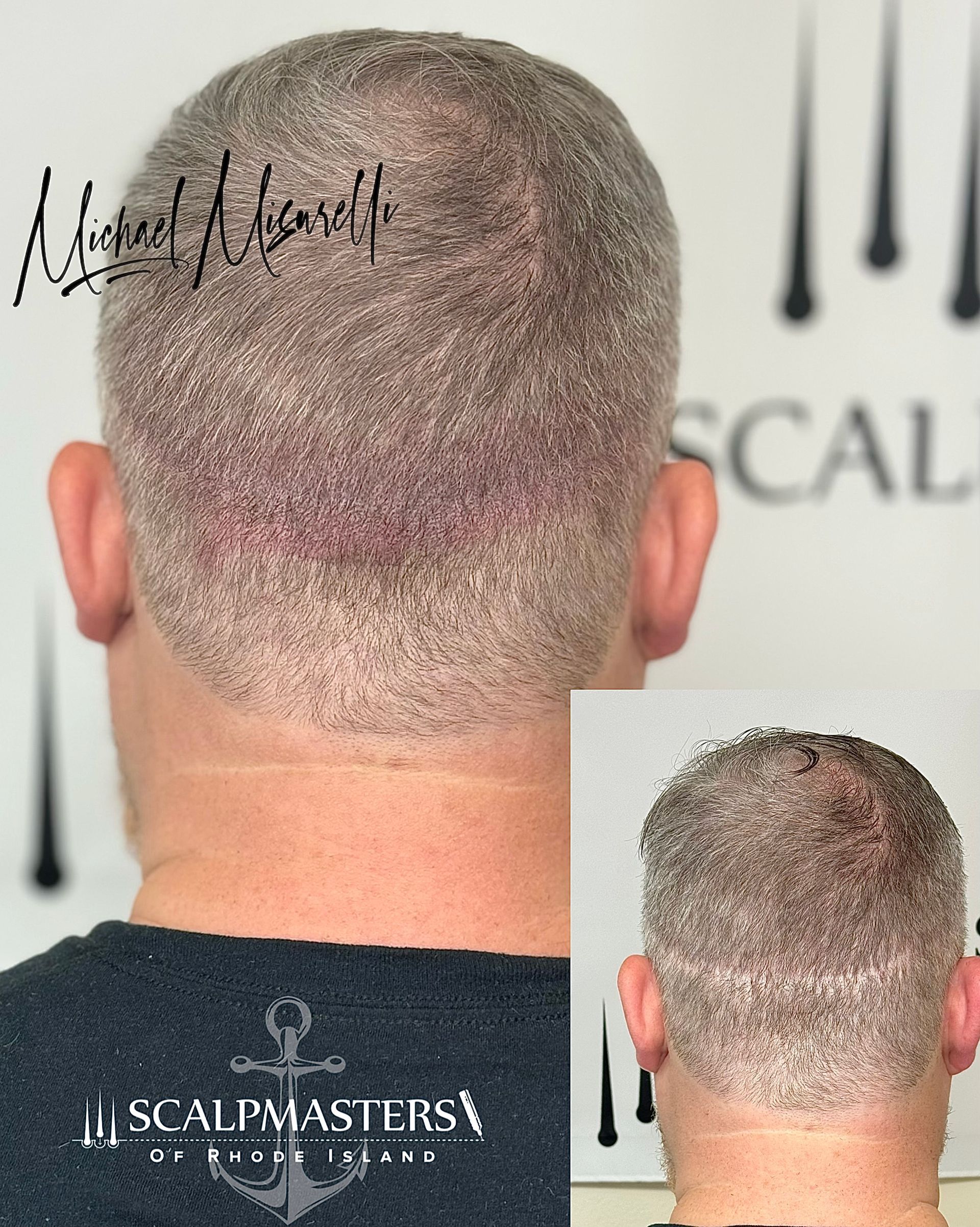 Scalp Micropigmentation Clinic