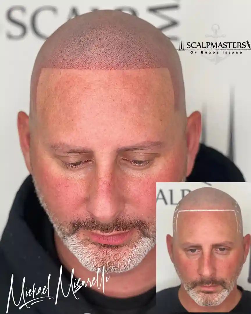 man with a freshly treated, natural-looking SMP hairline - scalp micropigmentation cranston