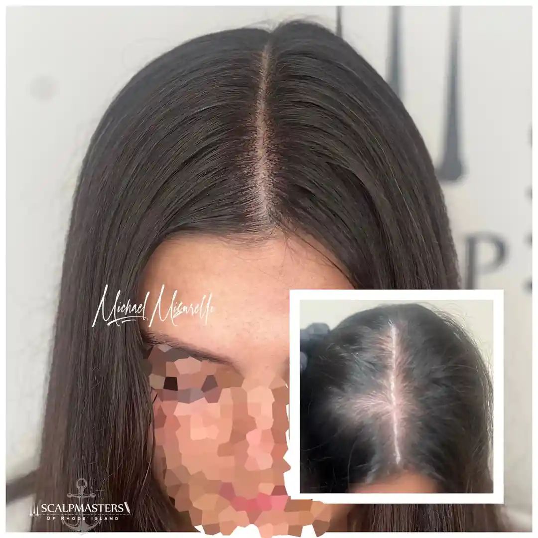 woman with hair loss - scalp micropigmentation for women