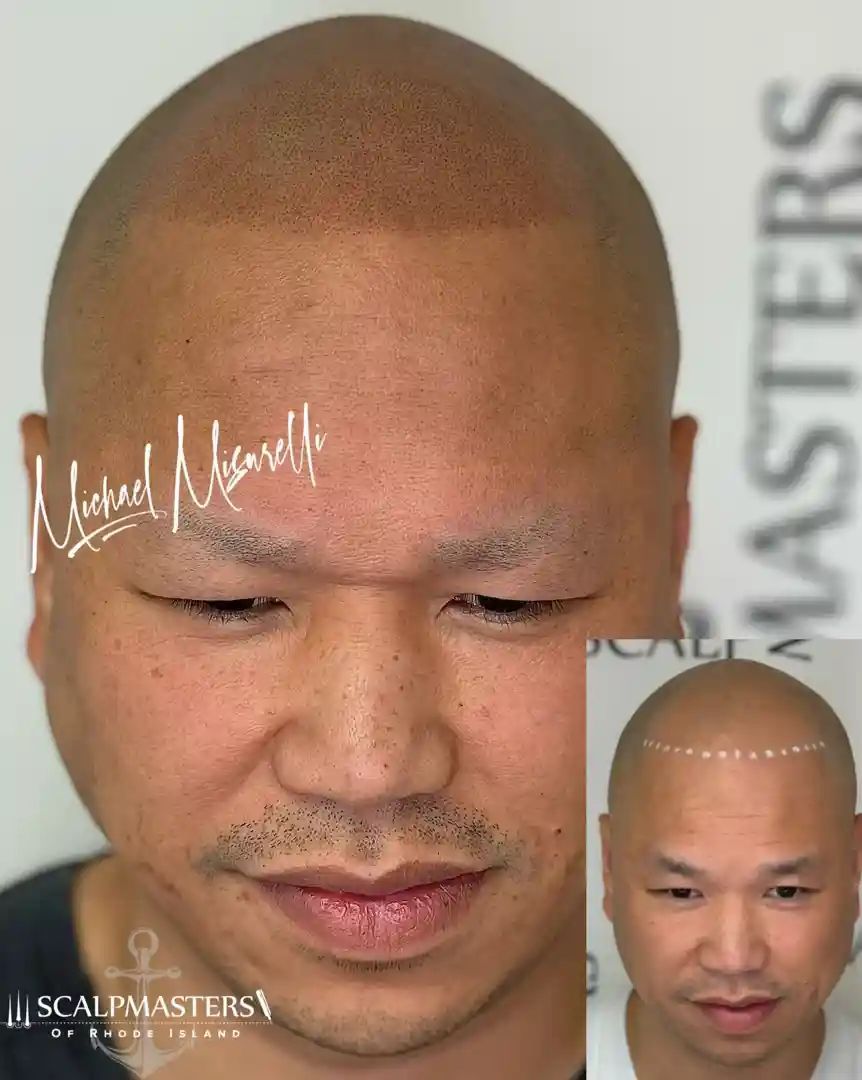 scalp micropigmentation clinics near me