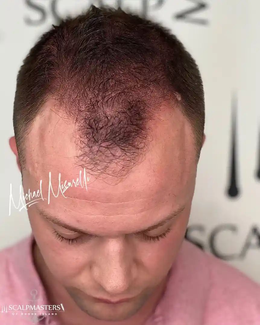 restore thinning hairline
