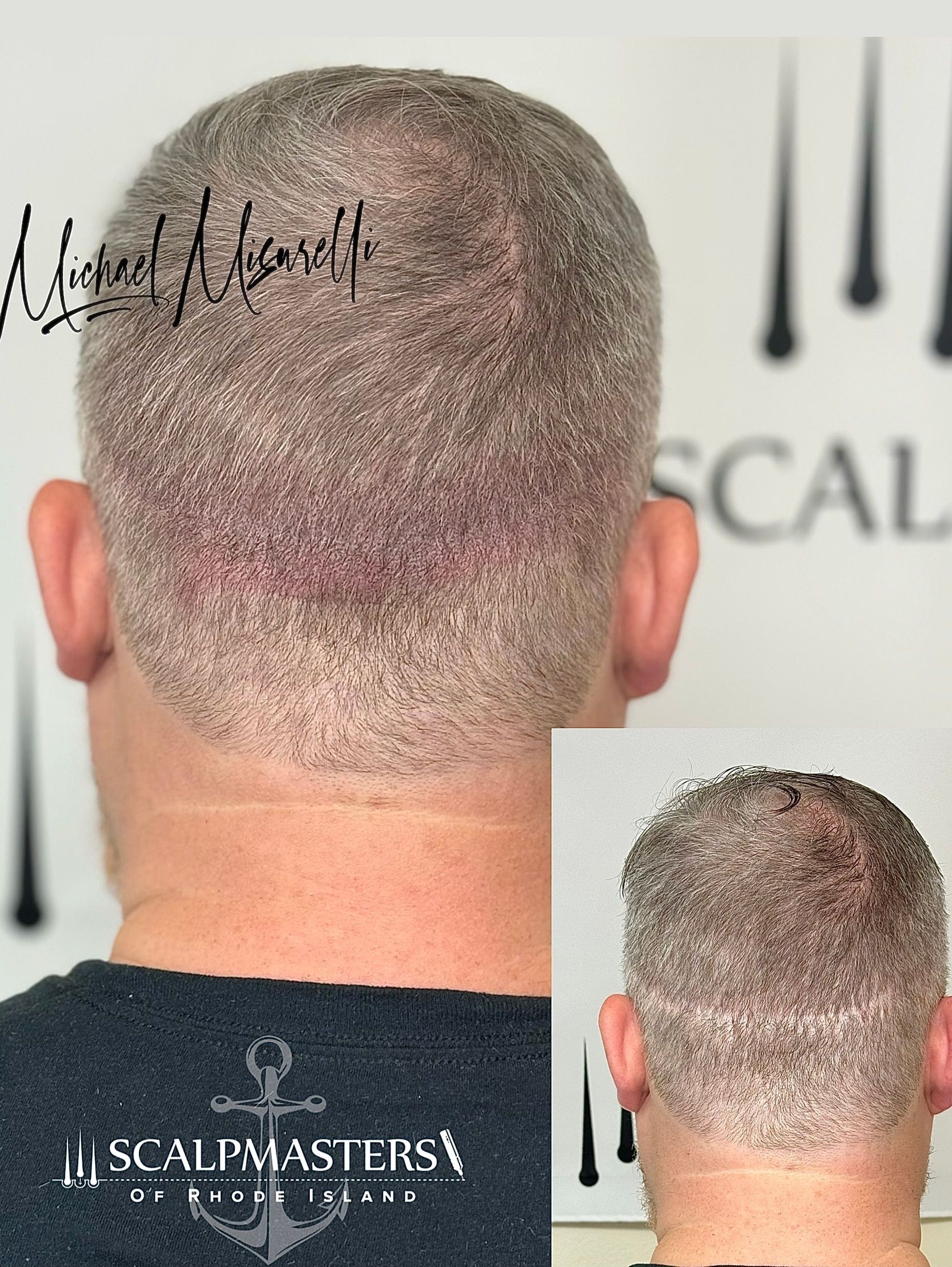 Scalp Micropigmentation for Women