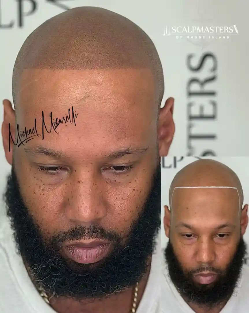 Massachusetts hair loss treatment - hair loss treatment MA