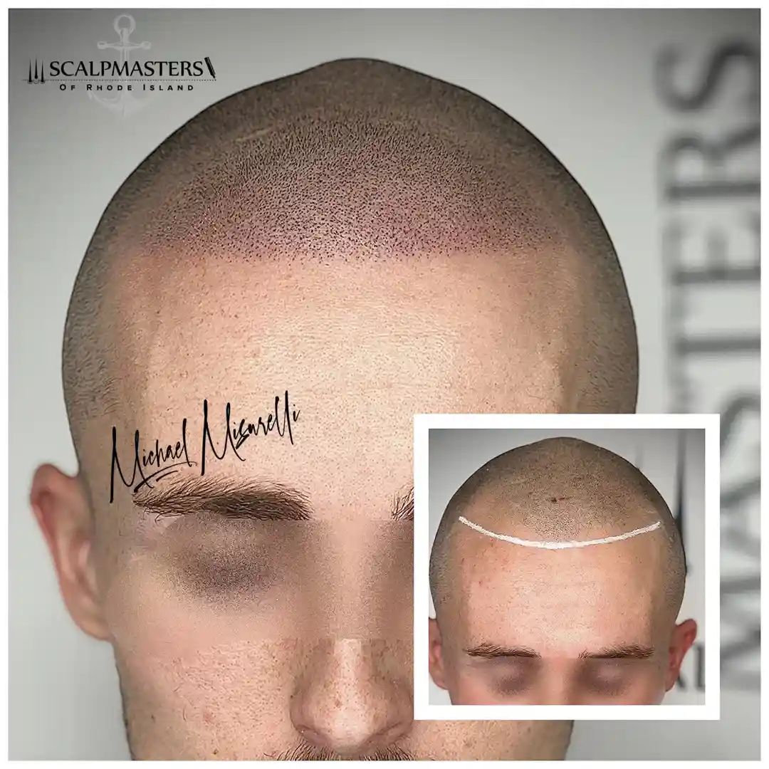 scalp micropigmentation before and after