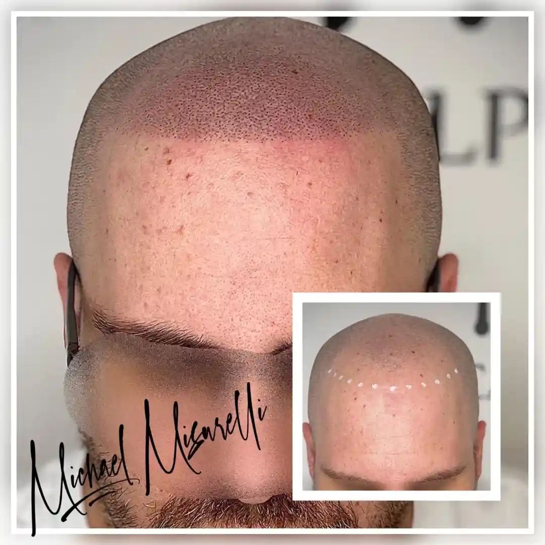 hairline reconstruction cost
