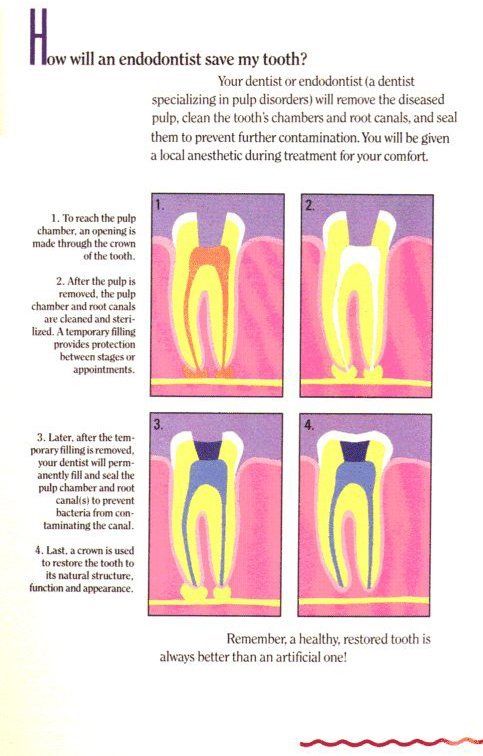 dental crowns Columbia, SC