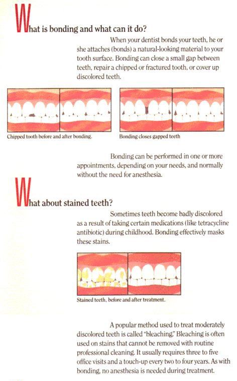 dental crowns Columbia, SC