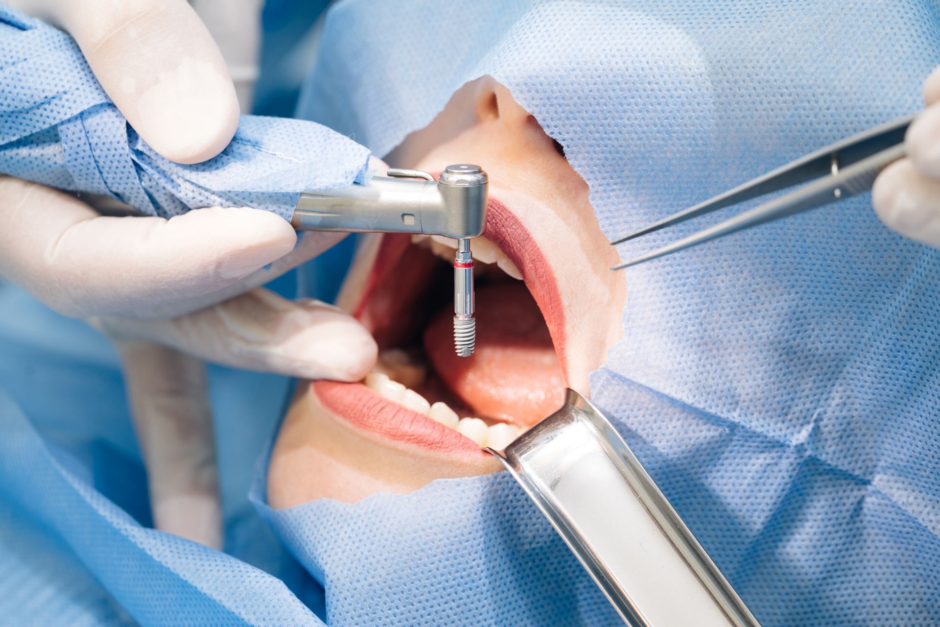 dentists placing an implant