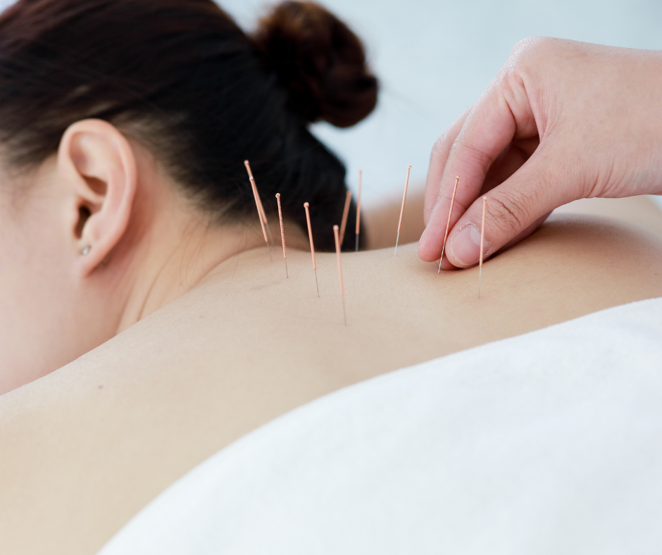 The Power of Acupuncture: Ancient Healing for Modern Health | Rosebank