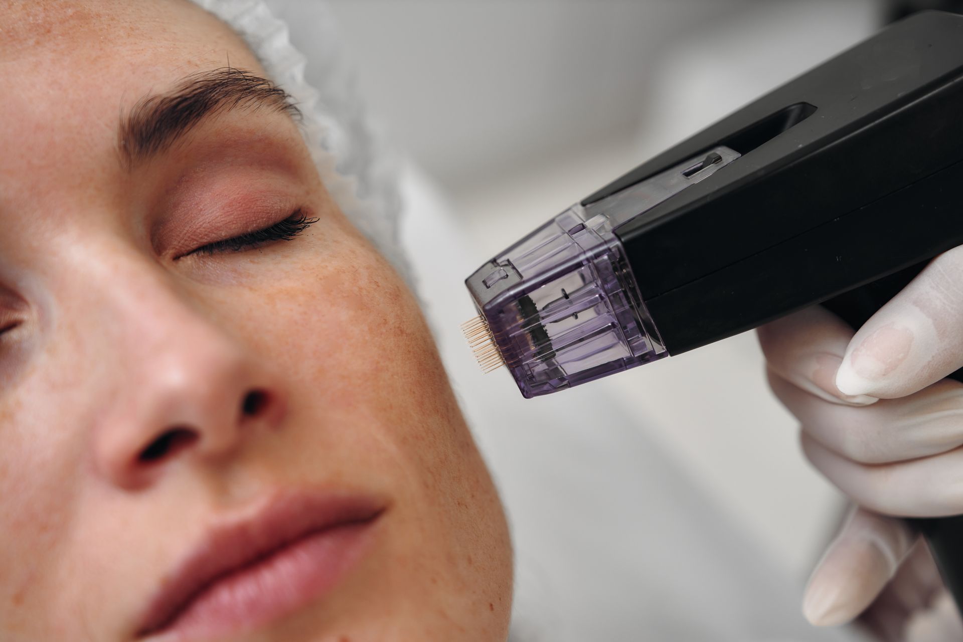 Close-up of a woman receiving a microneedling treatment on her cheek by a gloved hand