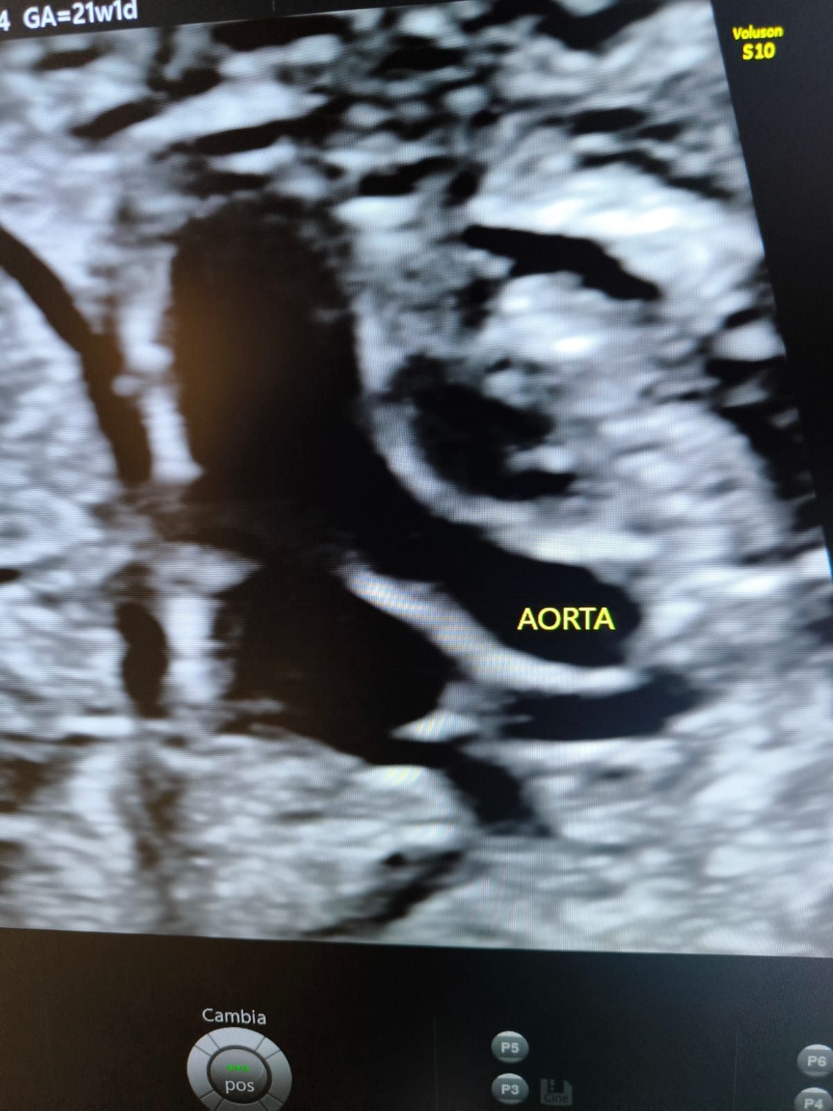 Un'ecografia di un bambino mostra l'aorta