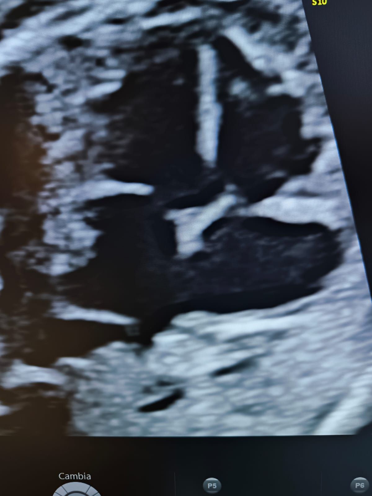 Un'immagine ecografica in bianco e nero del cuore di un bambino