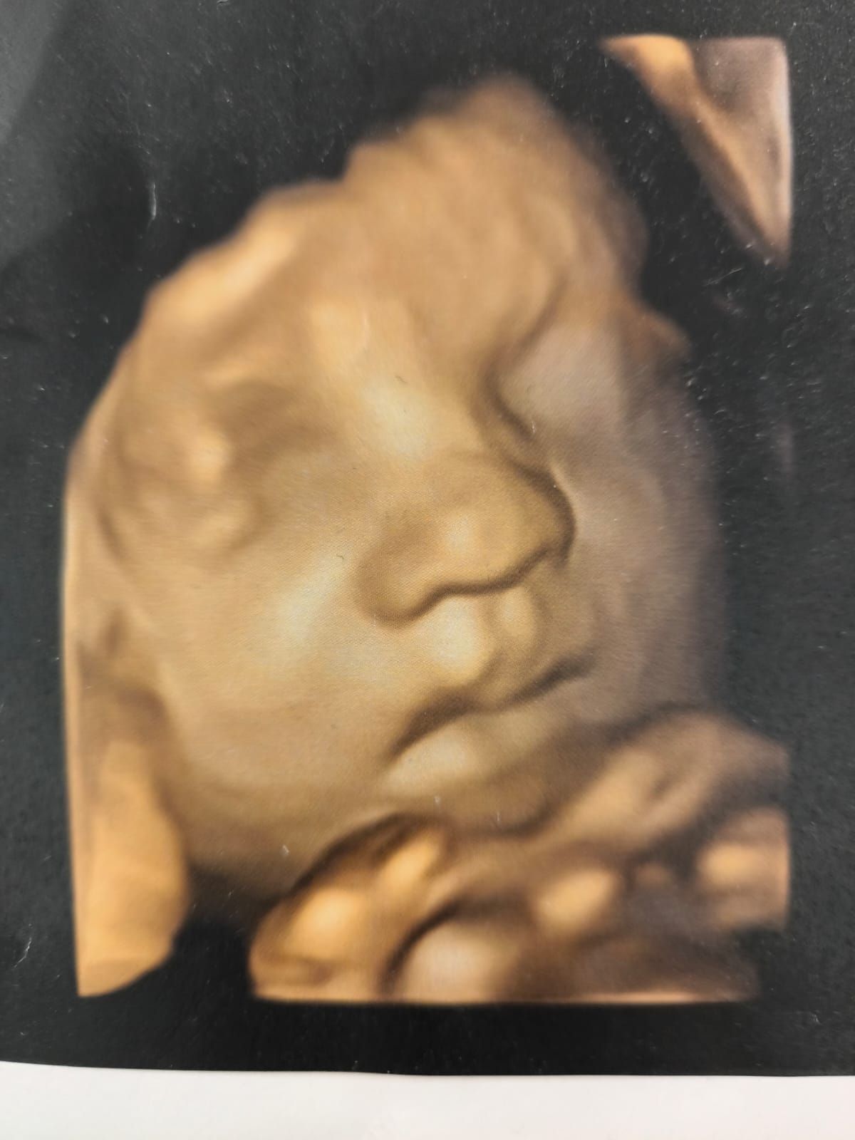 Viene mostrata un'ecografia del viso di un bambino