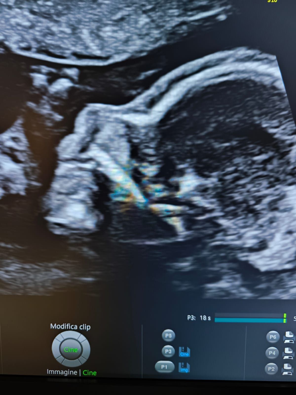 Primo piano di un'ecografia di un bambino nell'utero.