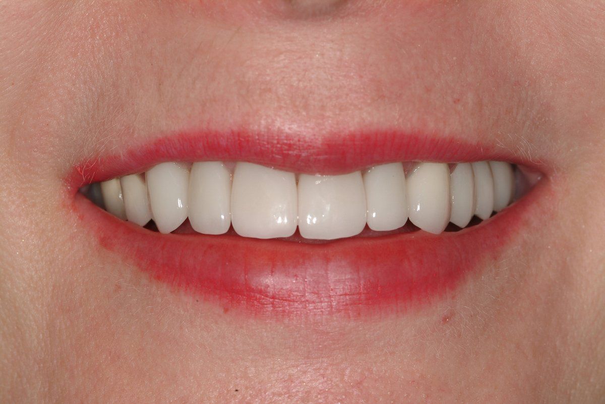 Beautiful Smile — Lyman, SC — Palmetto Smiles Prosthetic Dentistry