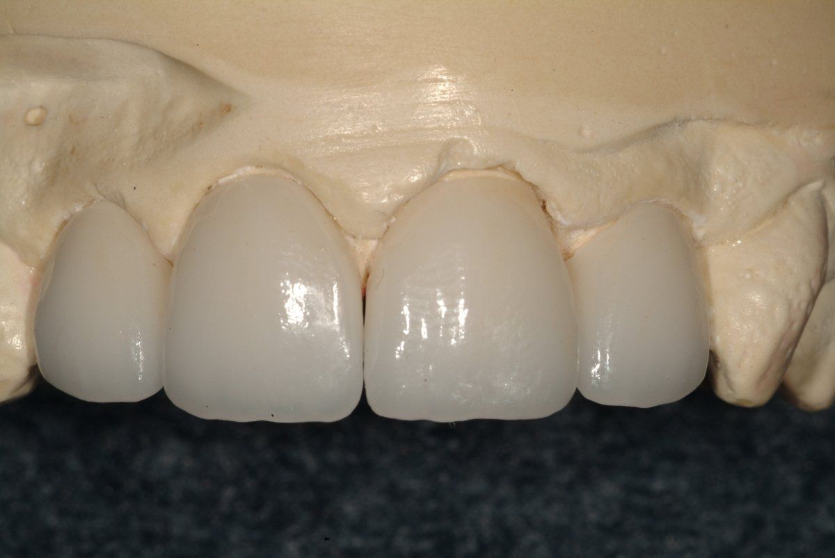 New Veneers — Lyman, SC — Palmetto Smiles Prosthetic Dentistry