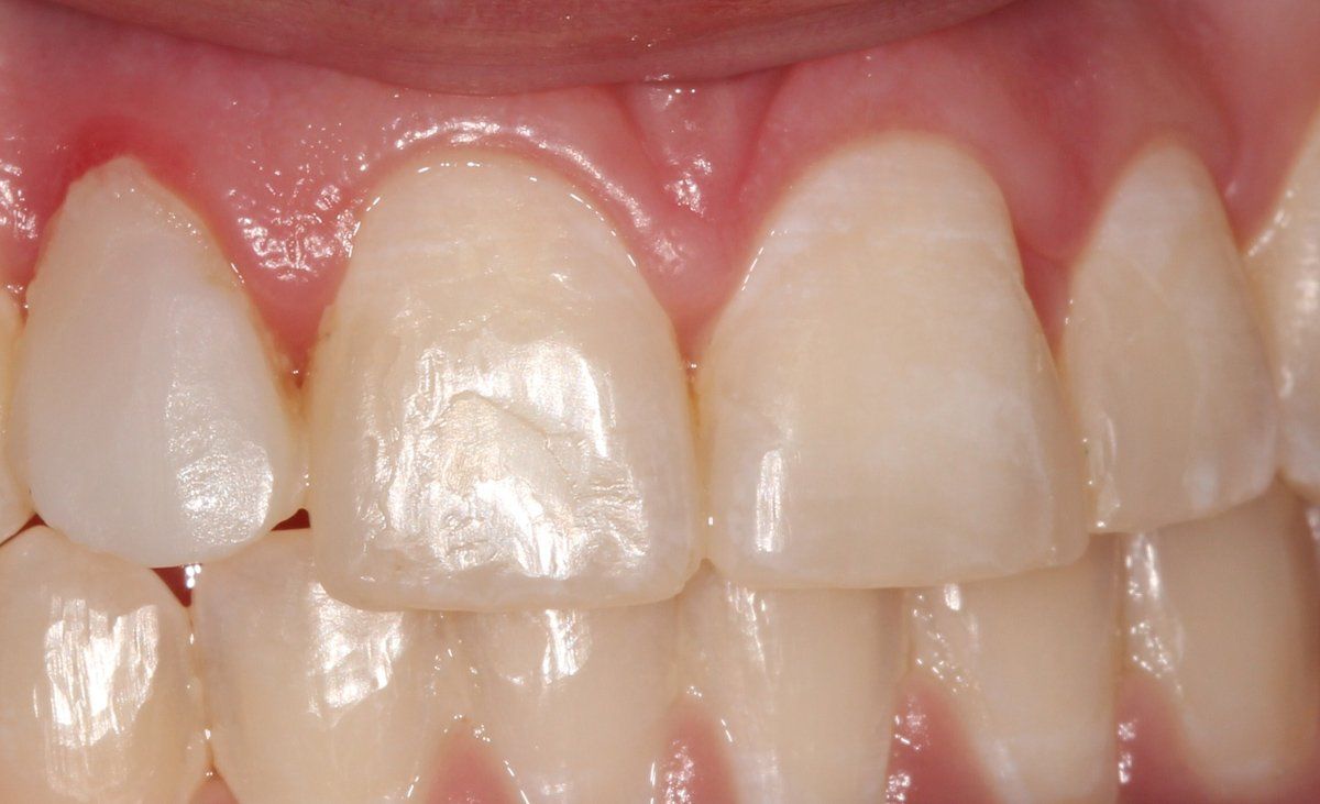Composite Filling After — Lyman, SC — Palmetto Smiles Prosthetic Dentistry
