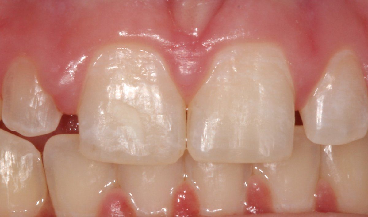 Composite Filling Before — Lyman, SC — Palmetto Smiles Prosthetic Dentistry