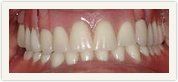 New Dental Dentures — Lyman, SC — Palmetto Smiles Prosthetic Dentistry