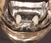 New Dental Implants — Lyman, SC — Palmetto Smiles Prosthetic Dentistry