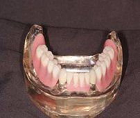 Dental Implants — Lyman, SC — Palmetto Smiles Prosthetic Dentistry