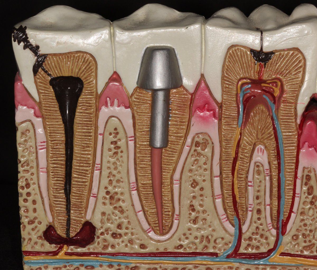 Root Canal — Lyman, SC — Palmetto Smiles Prosthetic Dentistry