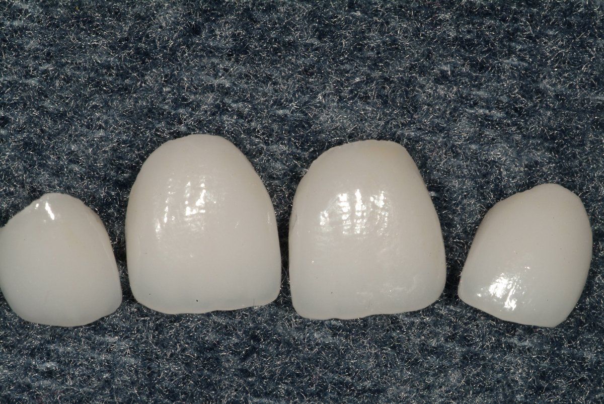 Veneers — Lyman, SC — Palmetto Smiles Prosthetic Dentistry