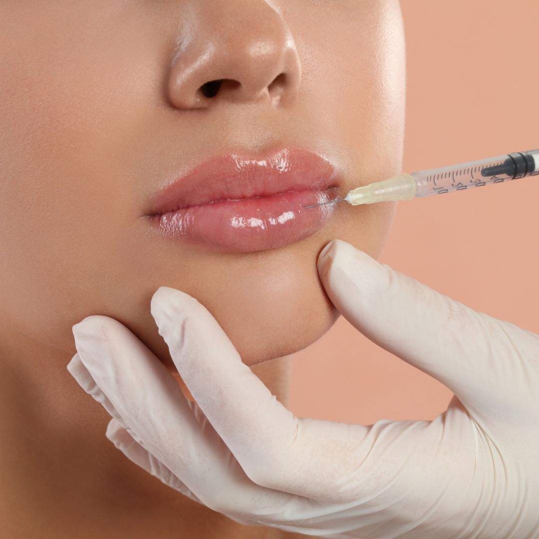 Lip Filler