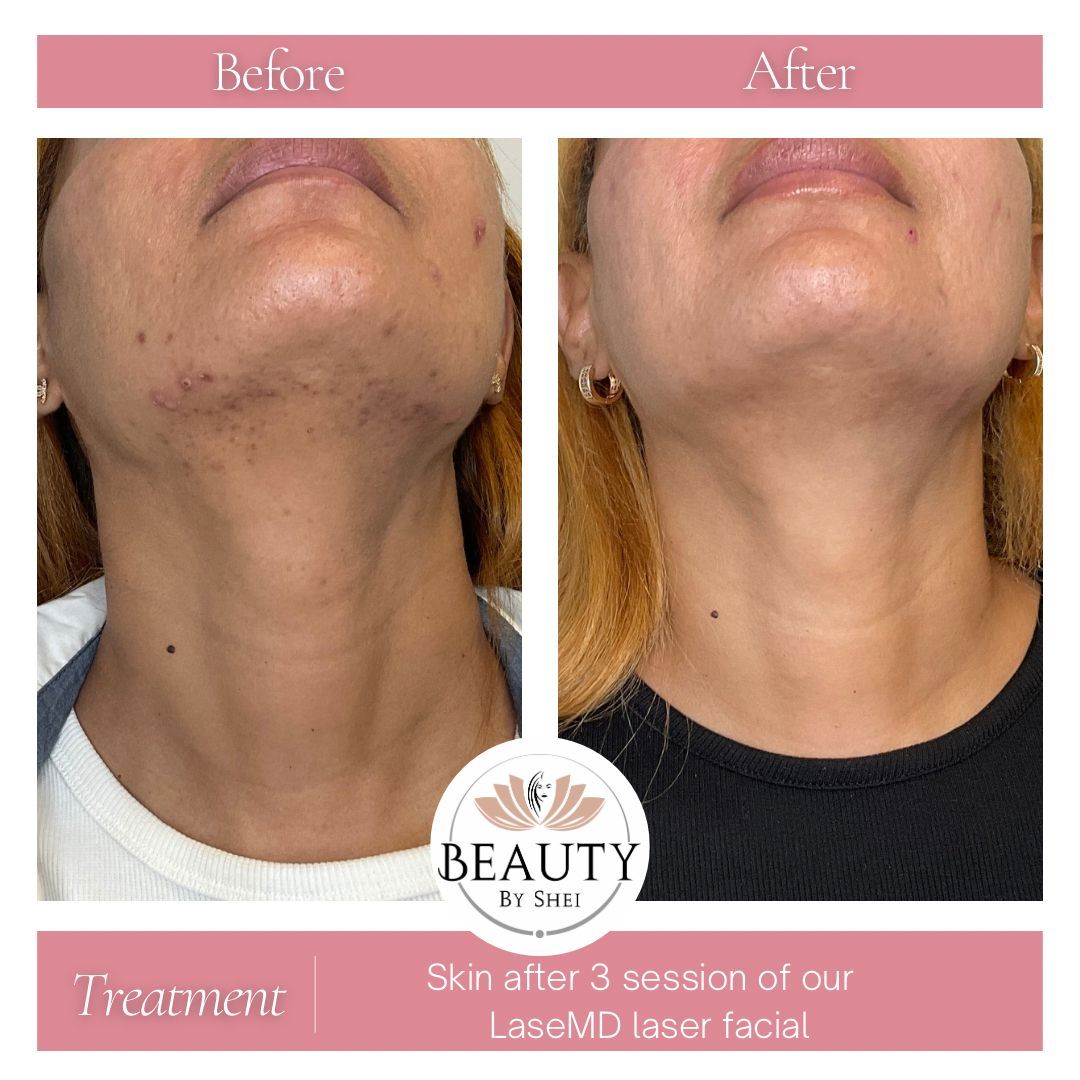 LaseMD Laser Facial Skin Rejuvenation Treatment Before & After