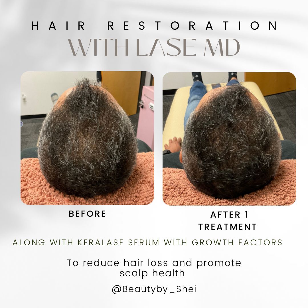 Hair Restoration Before & After Results