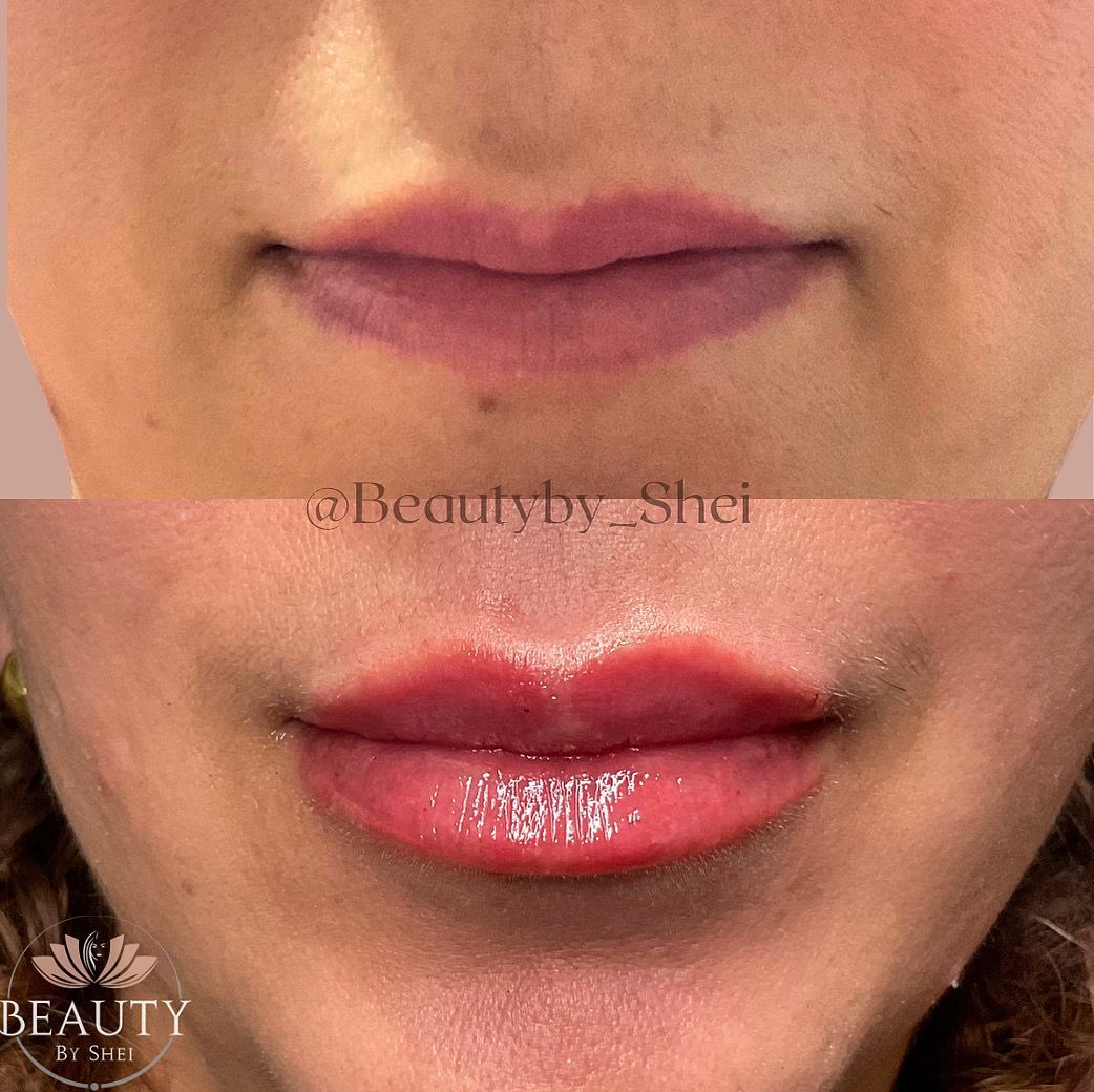 Lip Before & After