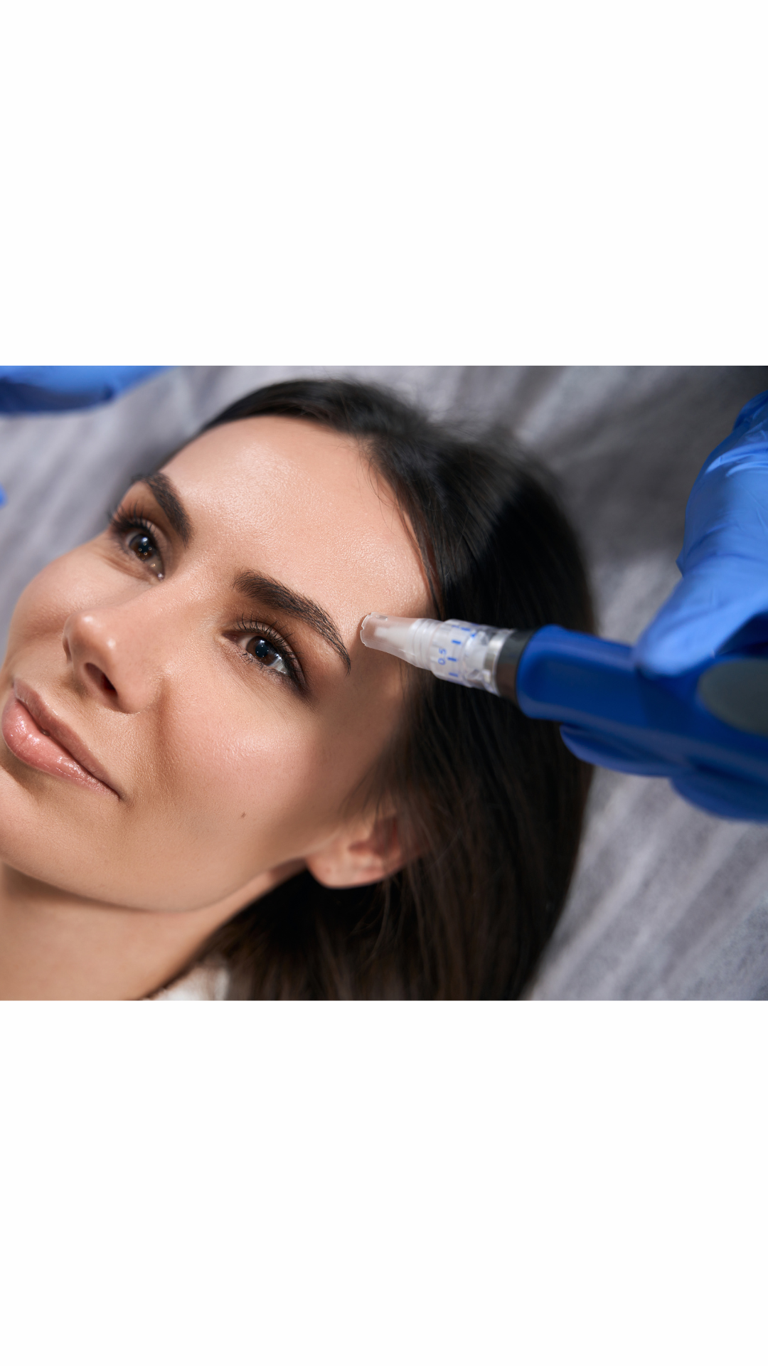 Woman receiving microneedling treatment or collagen induction on her forehead by a gloved hand.