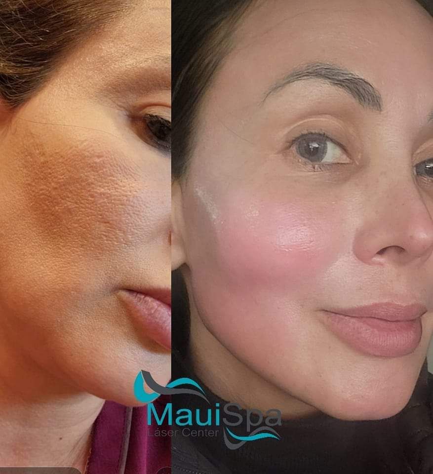 MAUI SPA LASER CENTER