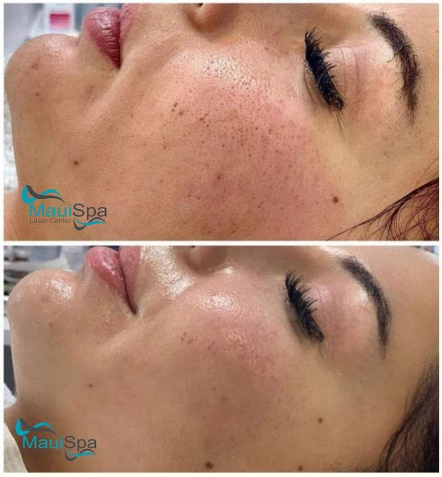 MAUI SPA LASER CENTER