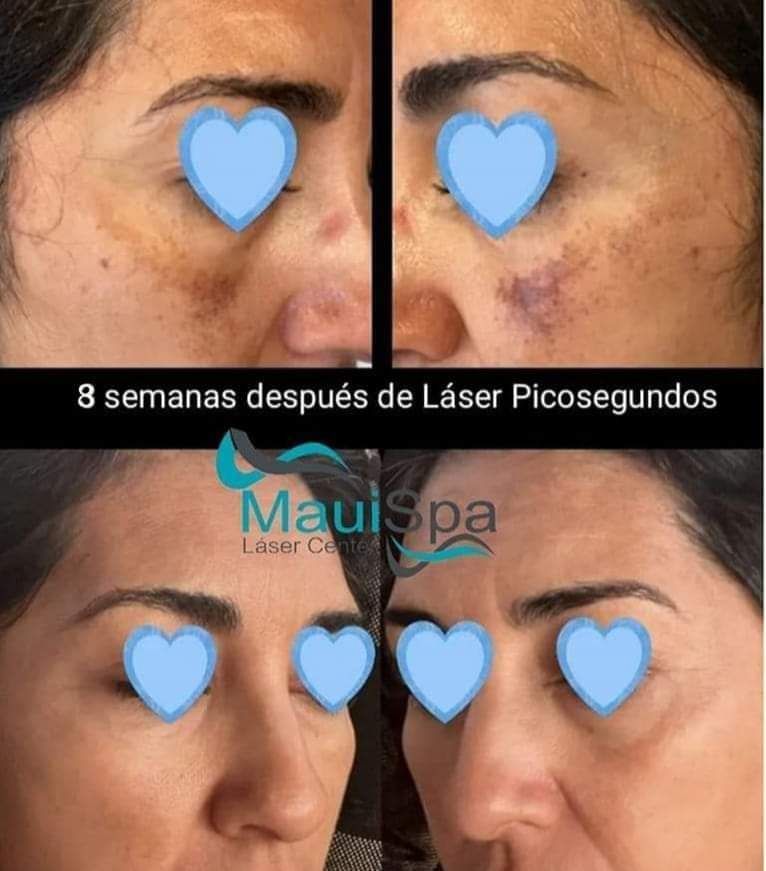 MAUI SPA LASER CENTER