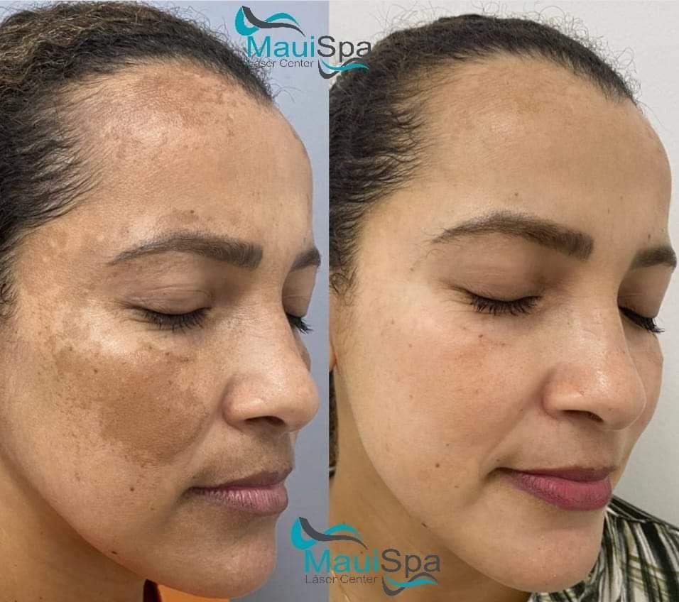 MAUI SPA LASER CENTER