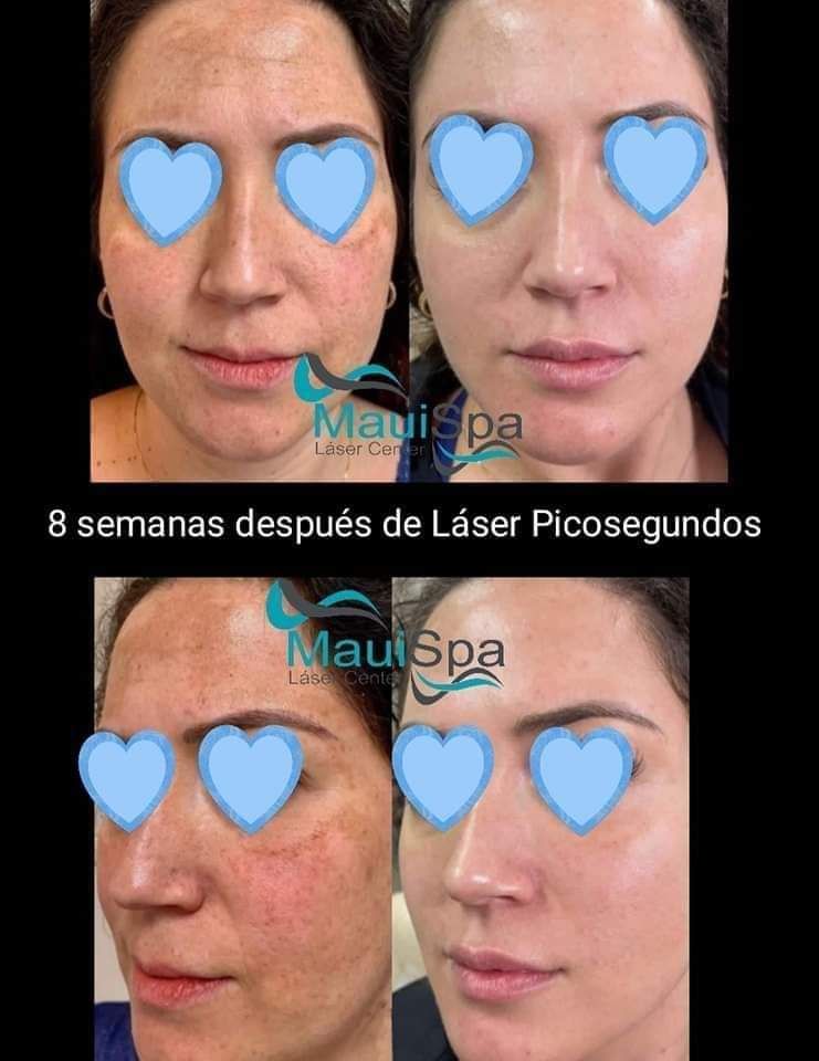 MAUI SPA LASER CENTER