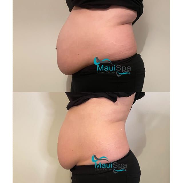 MAUI SPA LASER CENTER