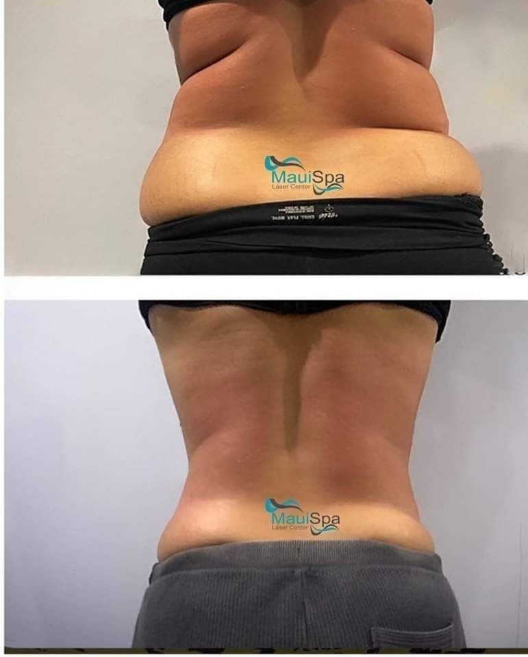 MAUI SPA LASER CENTER