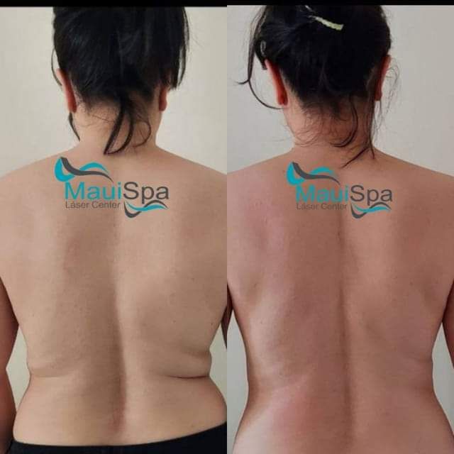 MAUI SPA LASER CENTER - hifu 4