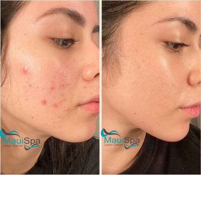 MAUI SPA LASER CENTER