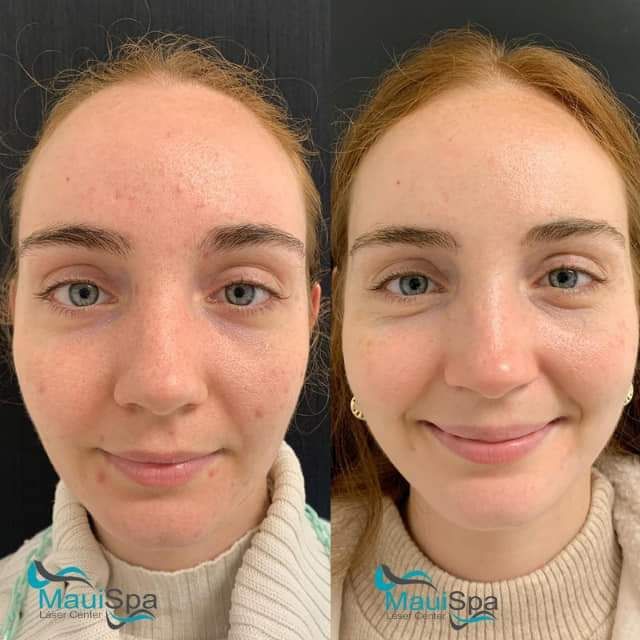 MAUI SPA LASER CENTER - acné