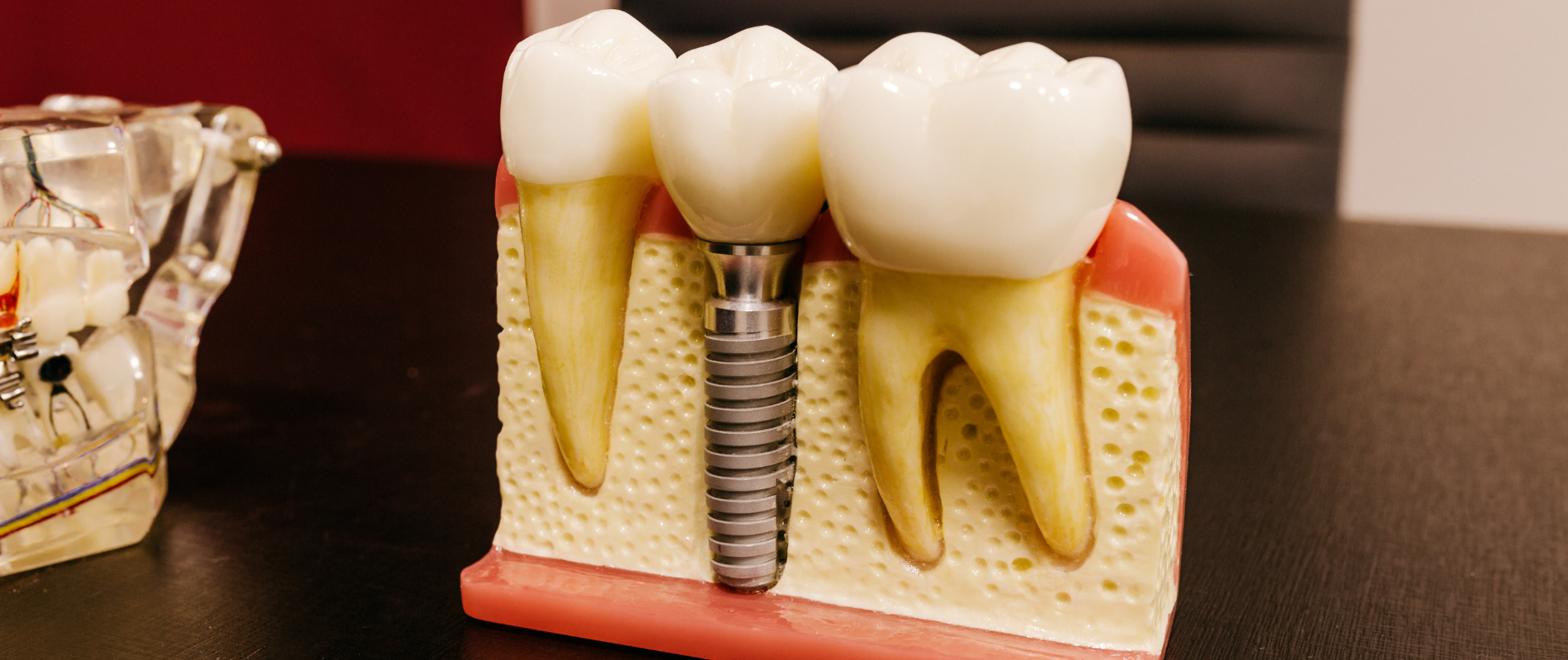 Grazie all'innovativa Implantologia è possibile ottenere una dentatura completa e funzionale in meno
