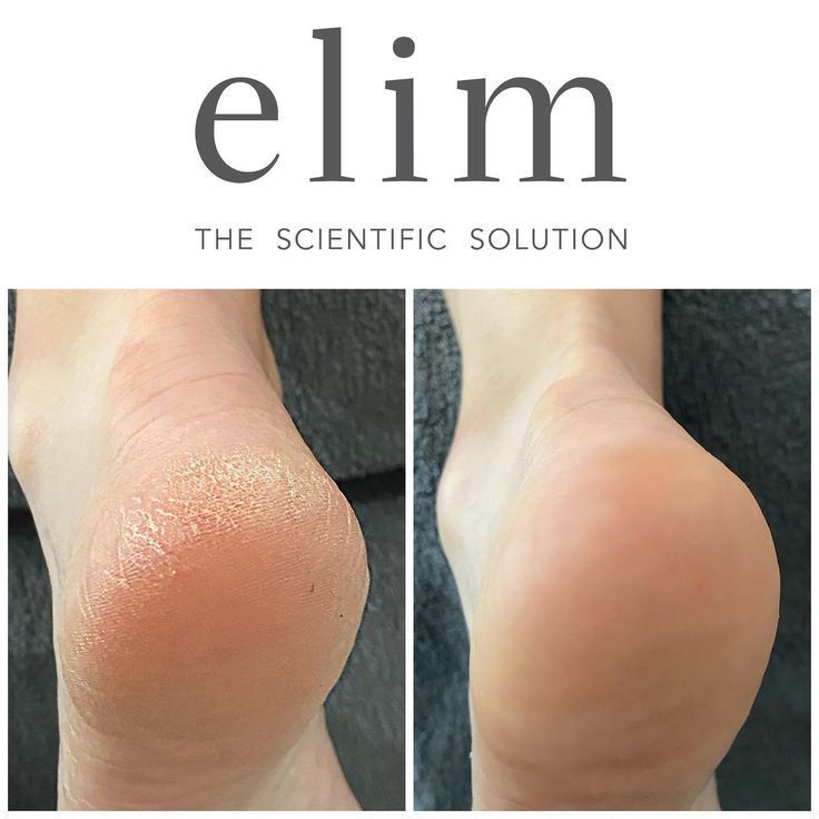 Before and after view of heels. Dry, cracked heel on the left, smooth heel on the right.