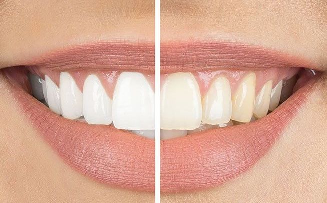 A woman 's teeth before and after whitening.