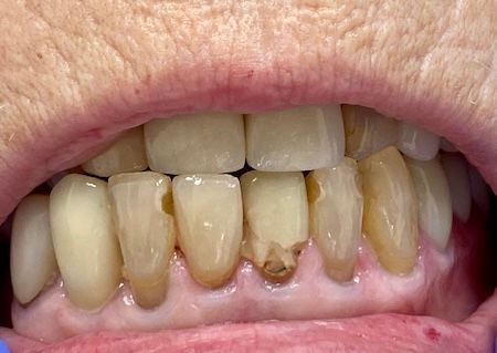A close up of a person 's teeth with a lot of plaque on them.