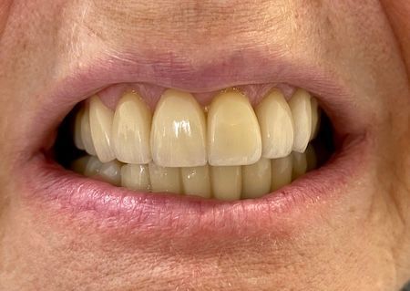 A close up of a person 's mouth with a lot of teeth.